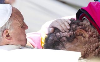 Pope hugs disfugured man